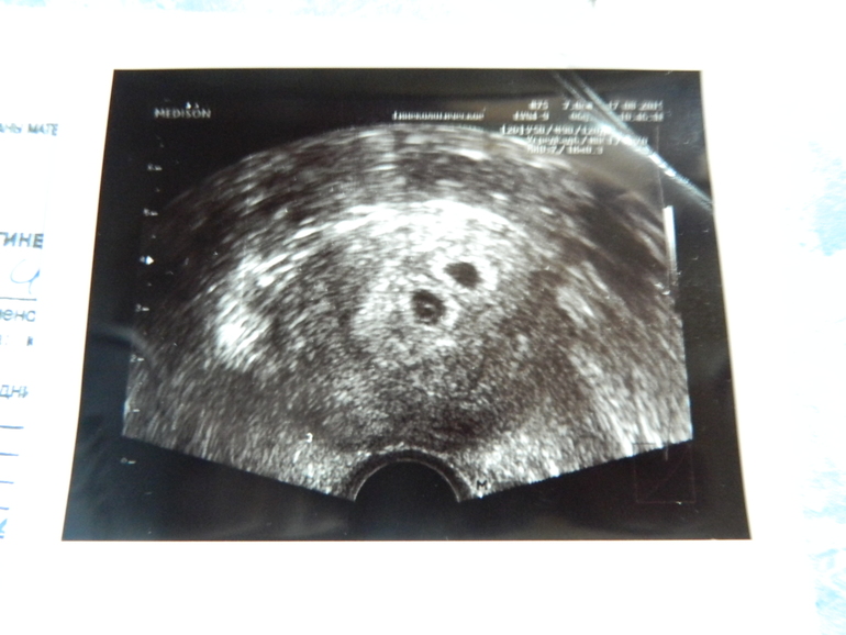 Как выглядит узи на 6 неделе. УЗИ двойни 4-5 недель беременности. УЗИ 6 недель беременности двойня. УЗИ на 5 неделе беременности двойня. УЗИ беременности 4 недели беременности двойня.