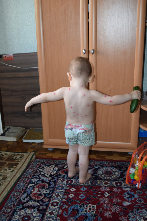 Подозрение на ветрянку