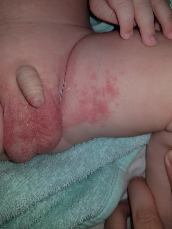 Симптомы аллергии на памперсы у детей: фото и лечение