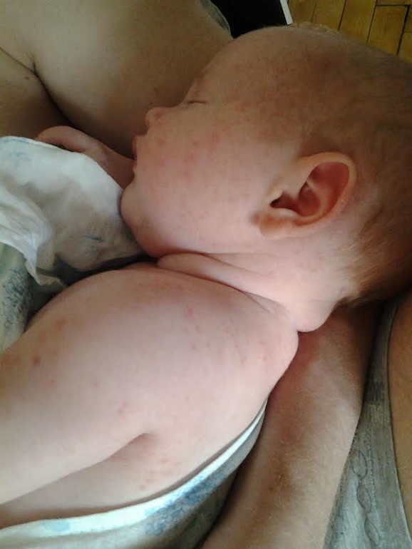 1,5 месяца. Высыпания на коже.