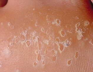 Что делать, если облазит кожа – лечение в Клинике Медитон