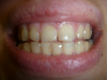 Итог моего ношения брекетов