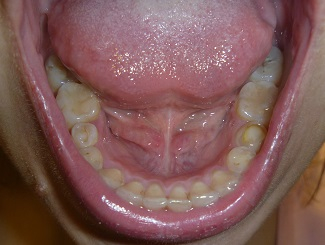 Итог моего ношения брекетов