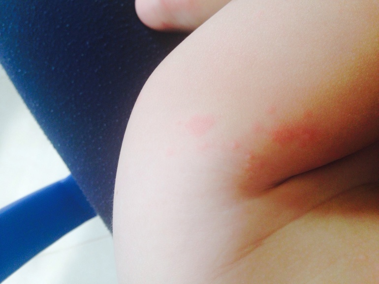 Аллергия?? Подскажите