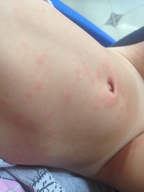 Аллергия?? Подскажите