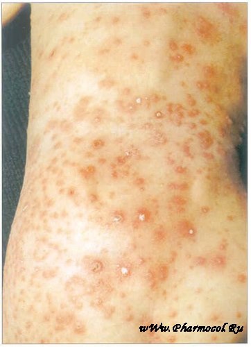 Прививка от ветряной оспы( ветрянка)