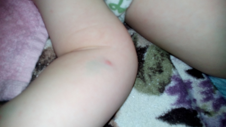 ветрянка??дубль 2