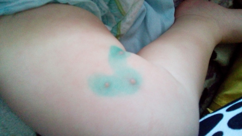 ветрянка??дубль 2