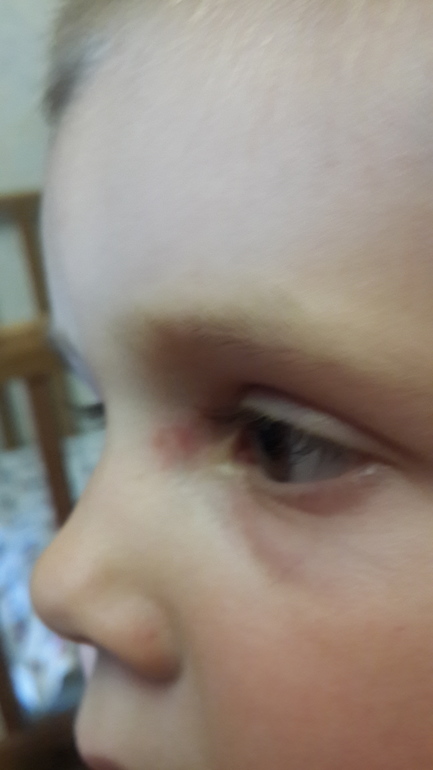 Аллергия это или нет?