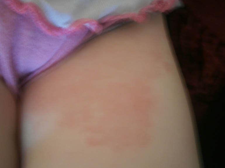 Ночью было нормально а утром вот такие большие пятна