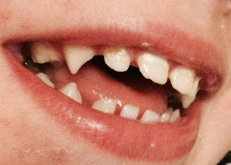 Белый налет на зубах!