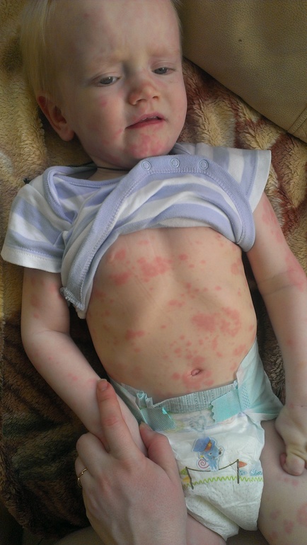 Девочки помогите!!!! Обсыпало всего.