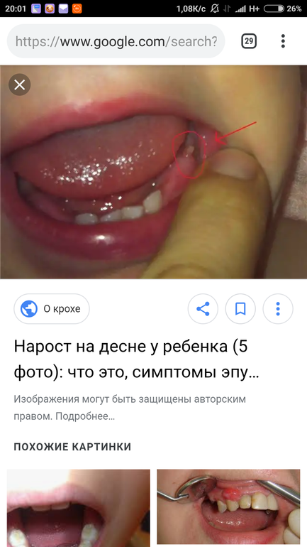 У ребёнка на десне шишка над молочным зубом: бегом к врачу!
