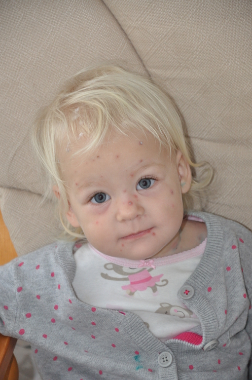 Ветрянка Варечка 1г. 4м.