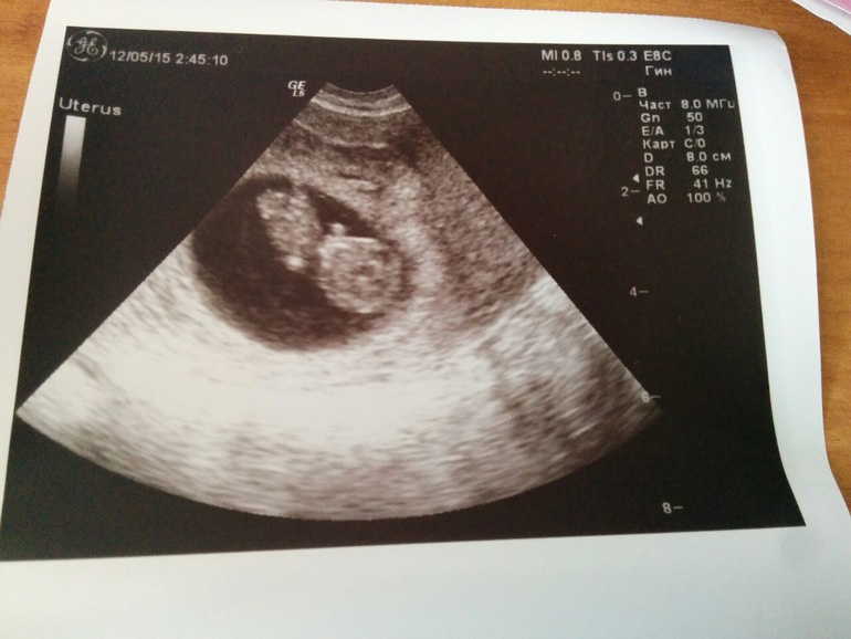 Десятка недели. УЗИ 10 недель беременности двойня однояйцевые. УЗИ плода в 5 недель с двойней. Плод 10 недель беременности двойня УЗИ. Снимки УЗИ беременности.