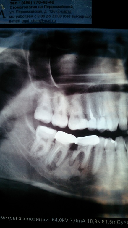 Изменение в кости