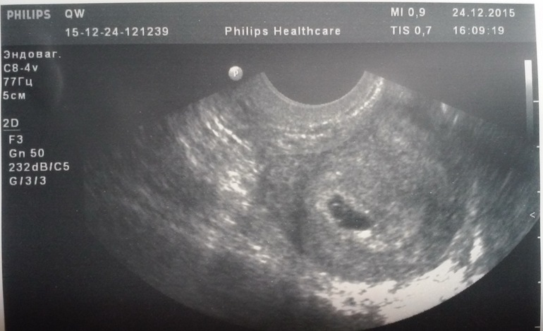 Неделя от зачатия форум. УЗИ 5-6 недель беременности. Снимок УЗИ беременности 5-6 недель. УЗИ 6 недель беременности. УЗИ 6.3 недели беременности.