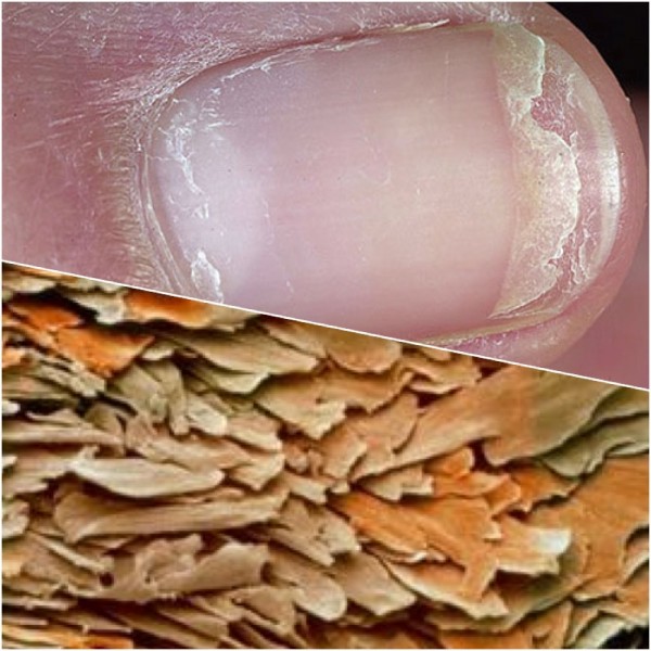 Как рассмотреть грибок ногтей под микроскопом?