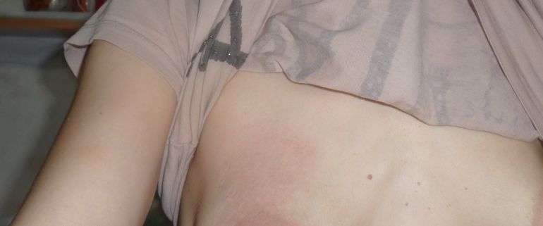 Это лактостаз или мастит? Что делать?