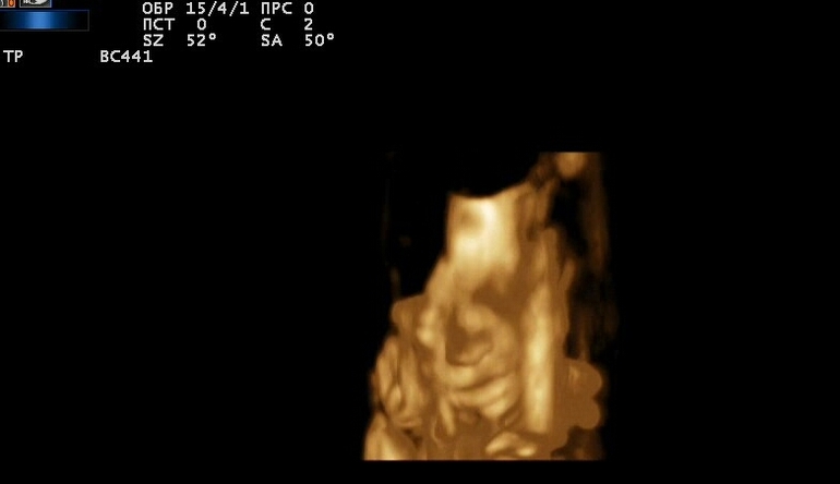 4д узи в 25 недель