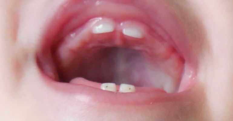 Беда с зубками, часть 2