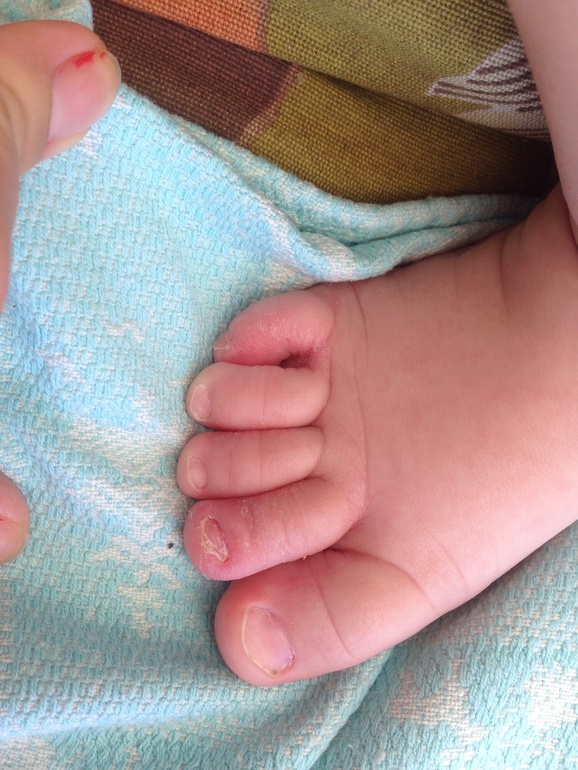 Пальчики грудничков. Пальчики на ножках у новорожденного. Пальцы на ногах у новорожденных. 6 Палец на ноге у новорожденного.