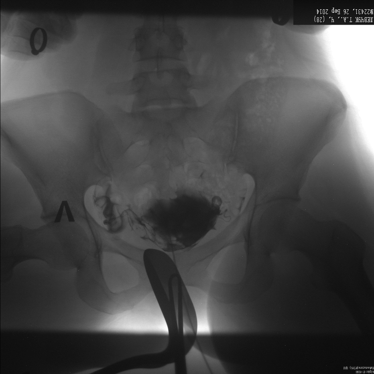 Метросальпингография, посмотрите, неужели все  так плохо?