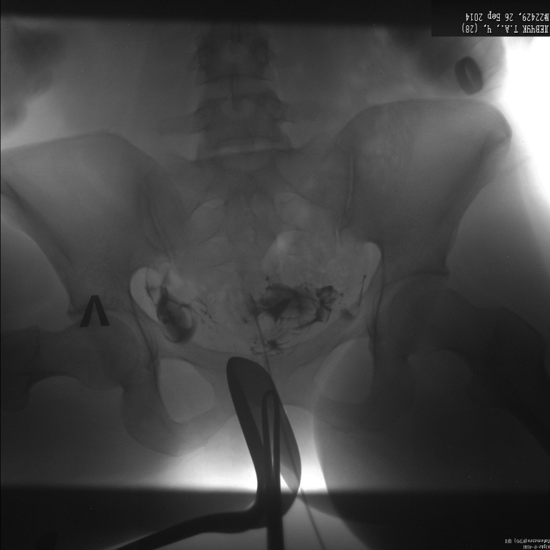 Метросальпингография, посмотрите, неужели все  так плохо?