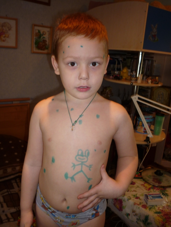 Ну вот, ветрянка и до нас добралась((