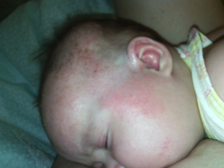 аллергия не понятно на что...