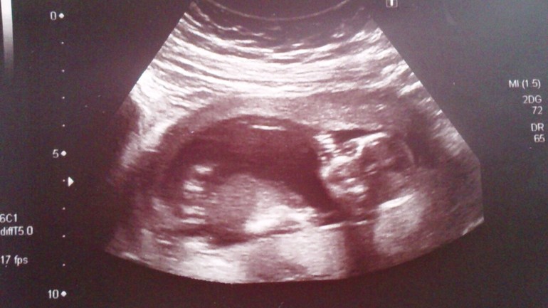 Отчёт о моей беременности с самого начала до 24-й недели