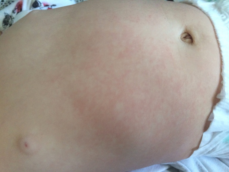 Идем на поправку и скорее всего это была....розеола?!?!?