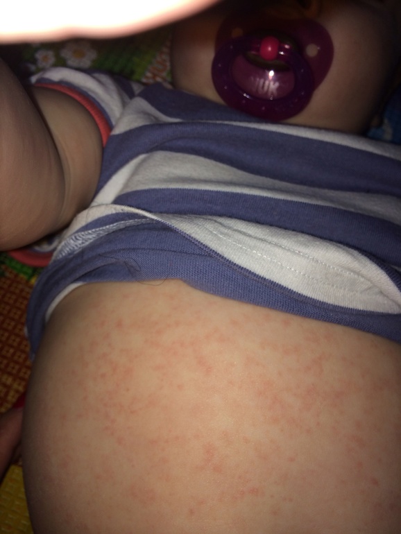 Идем на поправку и скорее всего это была....розеола?!?!?