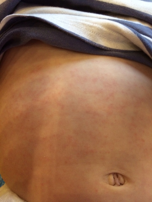 Идем на поправку и скорее всего это была....розеола?!?!?