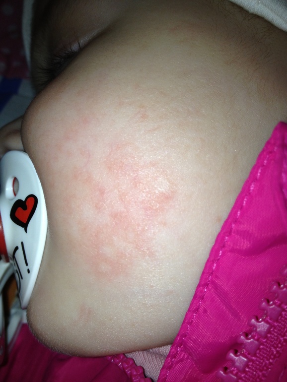 Пытаюсь прикрипить фото наших высыпаний.