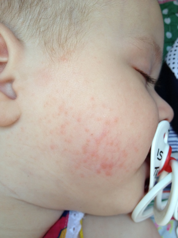 Пытаюсь прикрипить фото наших высыпаний.