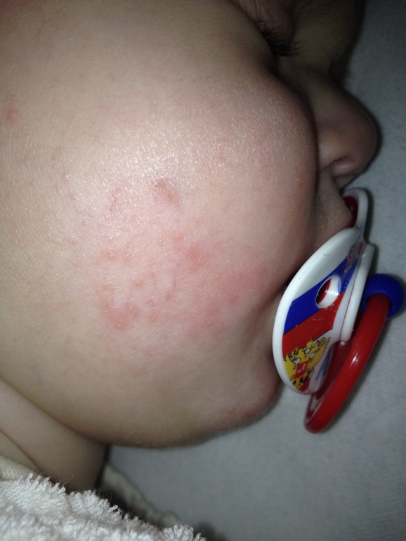 Пытаюсь прикрипить фото наших высыпаний.