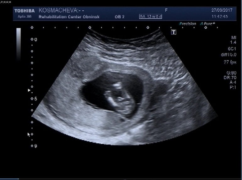 Фото узи мальчика на 14 неделе беременности